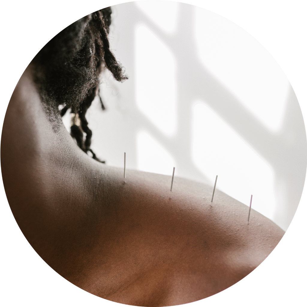 Acupuncture